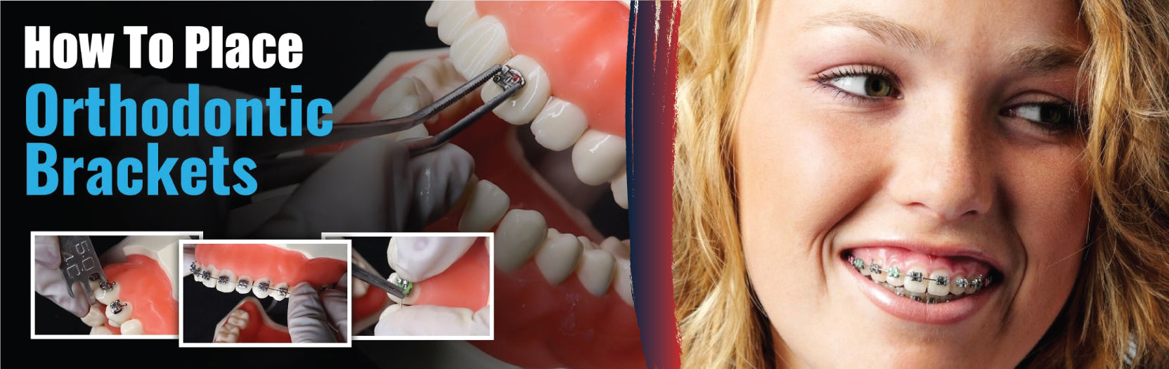 Step-by-Step Process of Using Orthodontic Bracket Placers - DDP Elite USA