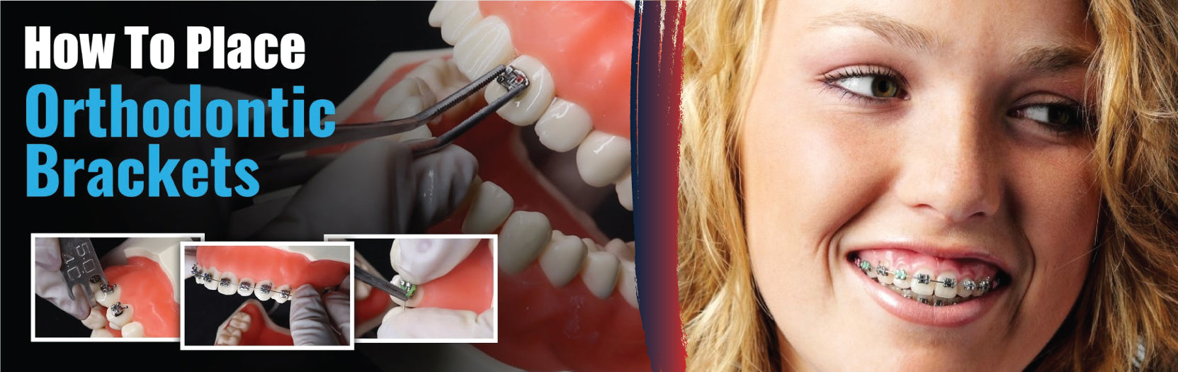 Step-by-Step Process of Using Orthodontic Bracket Placers