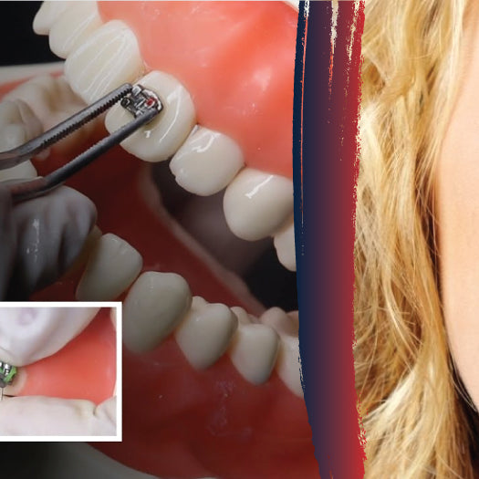 Step-by-Step Process of Using Orthodontic Bracket Placers - DDP Elite USA