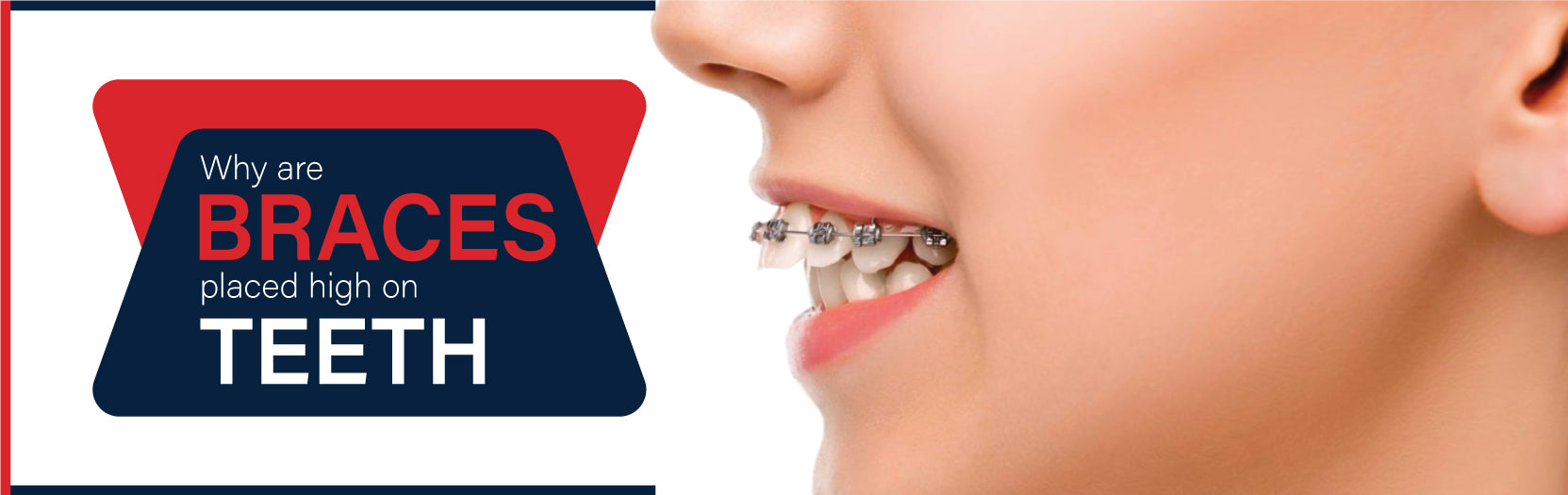 Why are braces placed high on teeth